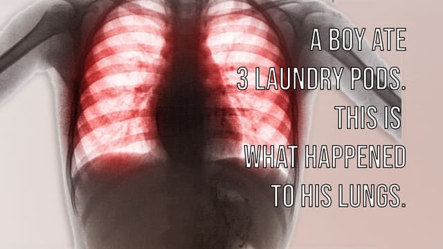 S01:E08 - A Boy Ate 3 Laundry Pods. This Is What Happened To His Lungs.