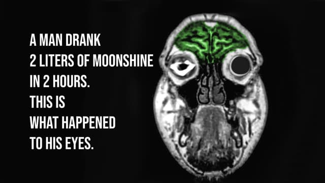 S01:E07 - A Man Drank 2 Liters Moonshine In 2 Hours. This Is What Happened To His Eyes.