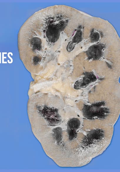 Affiche de S01:E03 - A Boy Ate 25 Laxative Brownies. This Is What Happened To His Kidneys.