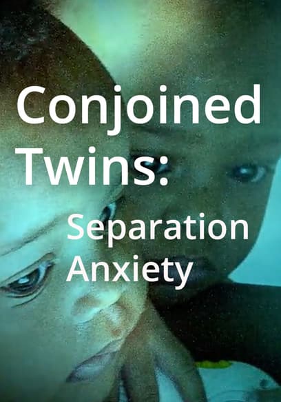 Conjoined Twins: Separation Anxiety