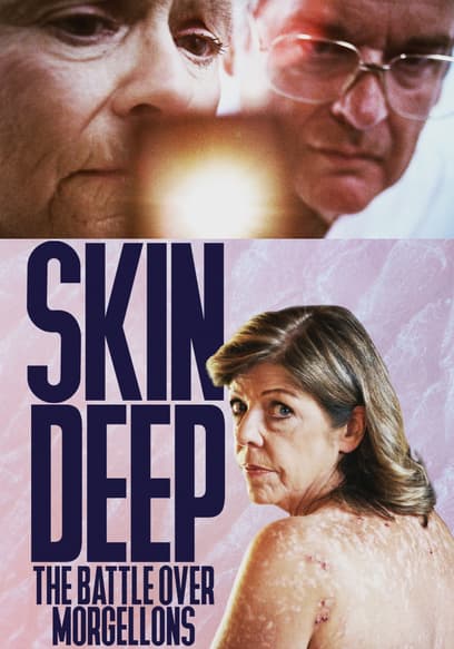 Skin Deep: The Battle Over Morgellons