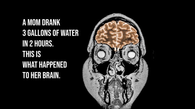 S01:E01 - A Mom Drank 3 Gallons Of Water In 2 Hours. This Is What Happened To Her Brain.
