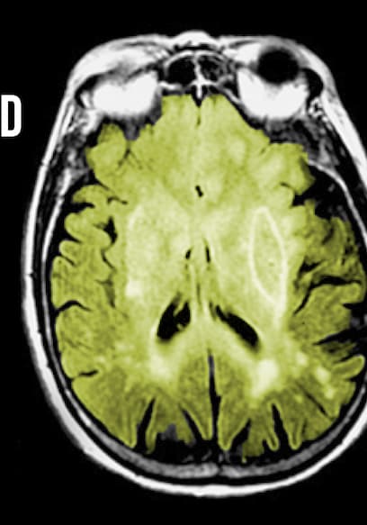 S01:E05 - A Febrile Toddler Played With His Cat. This Is What Happened To His Brain. poster
