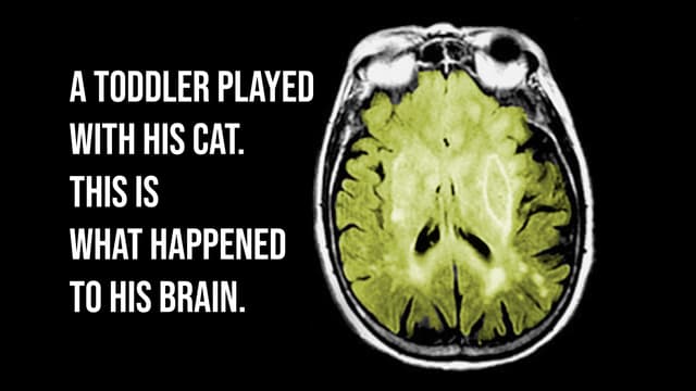 S01:E05 - A Febrile Toddler Played With His Cat. This Is What Happened To His Brain.