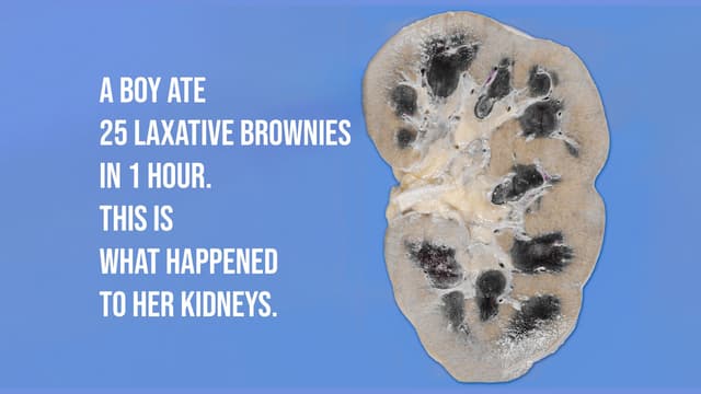 S01:E03 - A Boy Ate 25 Laxative Brownies. This Is What Happened To His Kidneys.